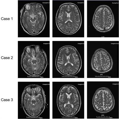 Analysis of Clinical Symptoms of Guillain–Barré Syndrome Induced by Heat Stroke: Three Case Reports and Literature Review